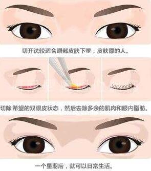 廣州廣大整形美容醫(yī)院切開雙眼皮術(shù)后效果