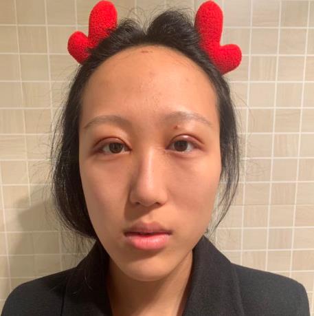 上海華美楊亞益眼部修復(fù)前效果圖