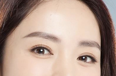 衡陽愛思特醫(yī)療美容醫(yī)院開眼角術后效果