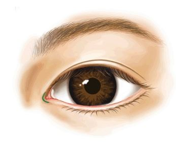 海南華美醫(yī)學(xué)美容醫(yī)院開(kāi)眼角術(shù)后效果