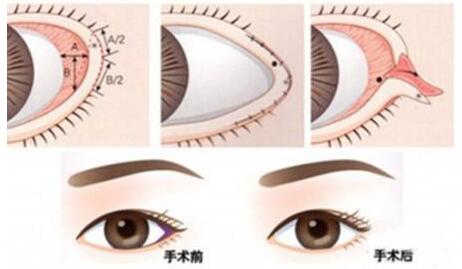 哈爾濱禾力康醫(yī)療開(kāi)外眼角術(shù)后效果