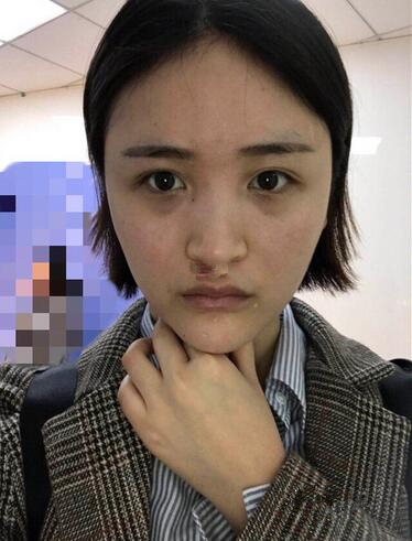 濟(jì)南鵬愛整形醫(yī)院怎么樣？濟(jì)南鵬愛王飏隆鼻案例分享