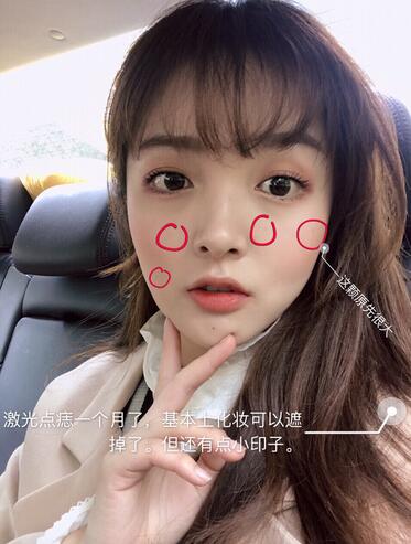 激光點(diǎn)痣一個(gè)月的效果 激光點(diǎn)痣一個(gè)月的效果