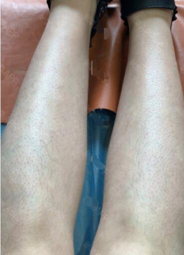 湖州尚麗醫(yī)療美容門診部宋君醫(yī)生激光脫毛案例分享