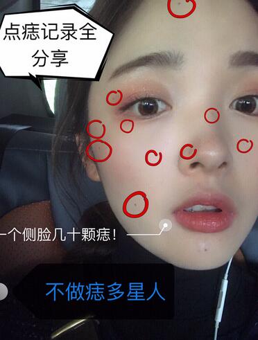 做激光點(diǎn)痣之前的效果 做激光點(diǎn)痣之前的效果