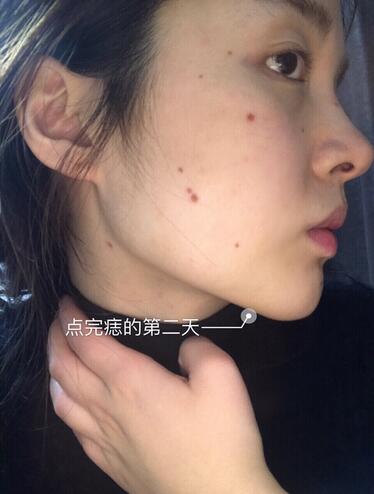 激光點(diǎn)痣的第二天 激光點(diǎn)痣的第二天