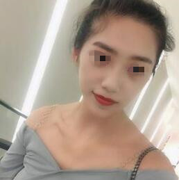 耳軟骨隆鼻中 耳軟骨隆鼻中