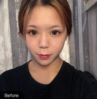 長(zhǎng)沙梵童王志軍自體脂肪填充案例效果對(duì)比