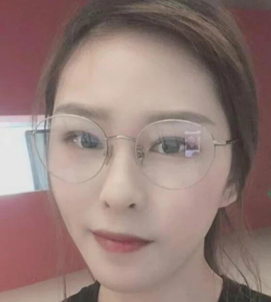 濟南海峽整形醫(yī)院陳娜醫(yī)生激光祛斑恢復(fù)效果