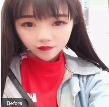 寧波熙美連桂賓醫(yī)生玻尿酸注射隆鼻案例效果對(duì)比圖