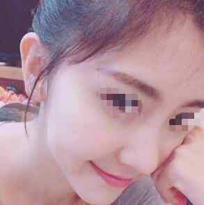 耳軟骨隆鼻手術(shù)之前 耳軟骨隆鼻手術(shù)之前