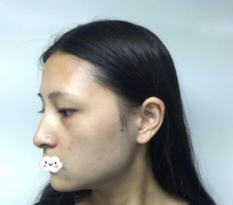 重慶美聯(lián)臣洪政槿醫(yī)生V臉整形案例效果圖對比