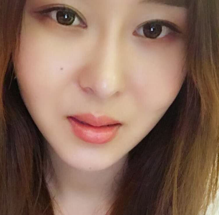 鄭州優(yōu)恩整形王波醫(yī)生玻尿酸豐唇案例效果對(duì)比圖