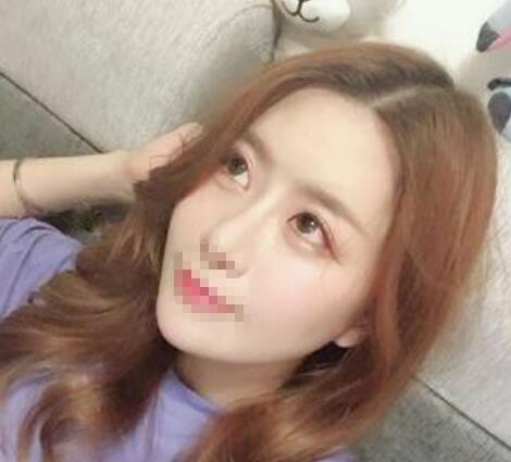 鄭州風(fēng)信子整形醫(yī)院雙眼皮案例