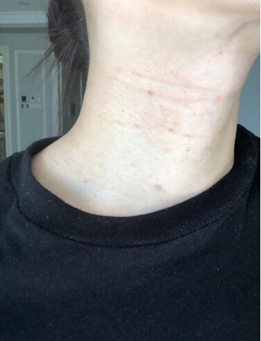 做完液態(tài)超聲刀注意什么。