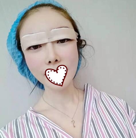 剛做完雙眼皮手術(shù)，還在恢復(fù)過(guò)程中