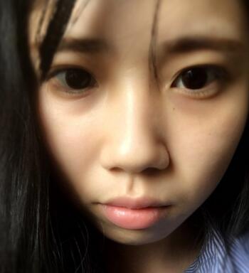 做完鼻骨縮窄手術(shù)七天后的樣子