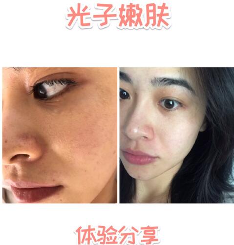 福州愛思特比華利整形林秋蓉醫(yī)生做光子嫩膚過程體驗