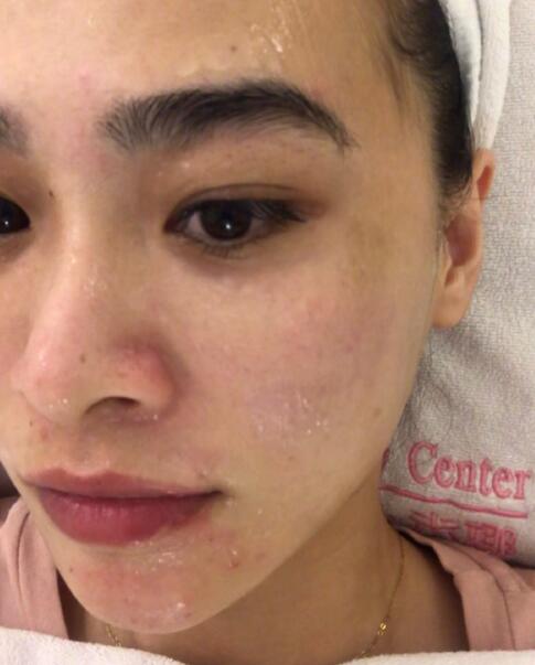 光子嫩膚后的效果分享