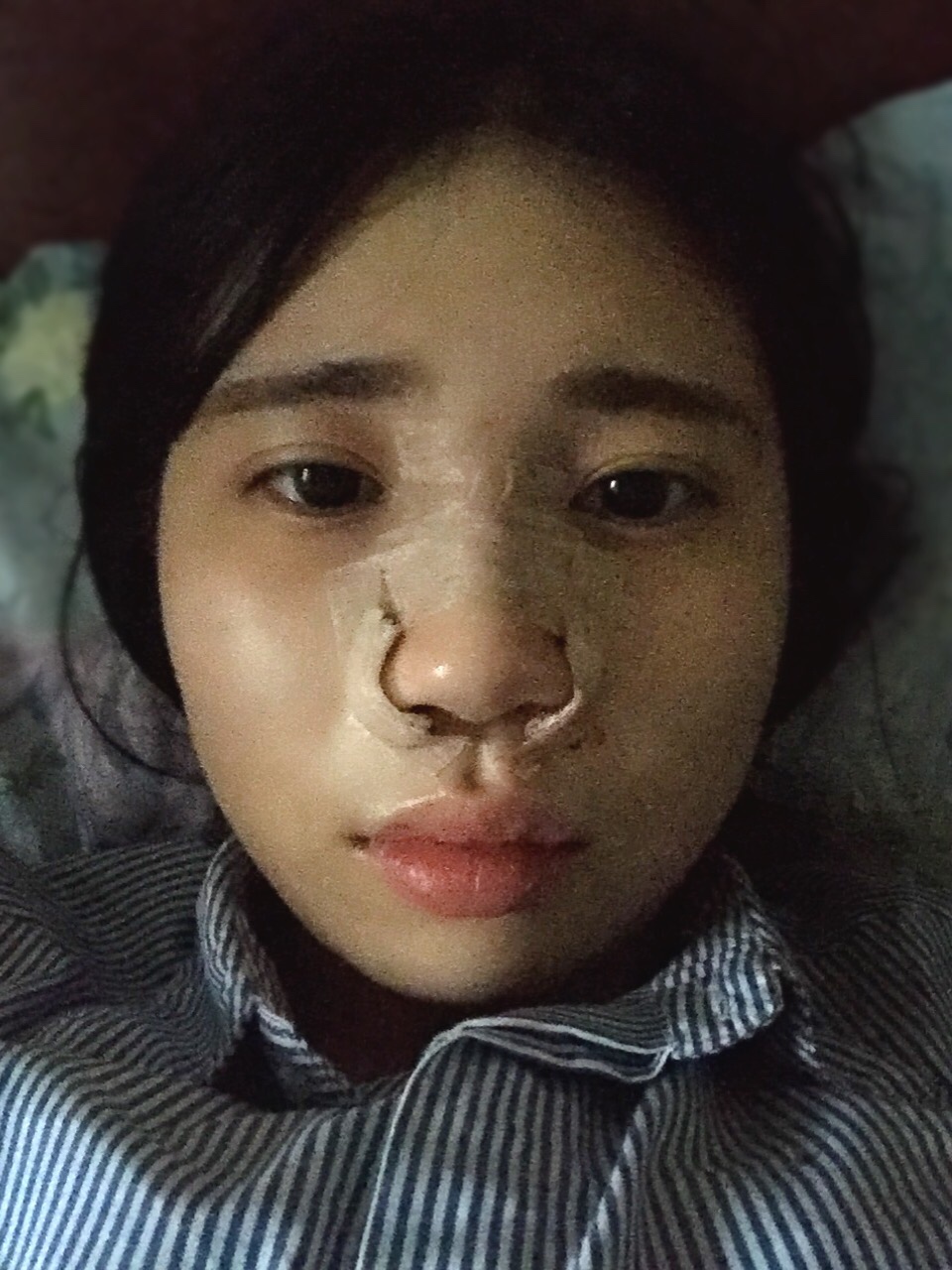 剛做完鼻骨縮窄手術(shù)時(shí)的樣子