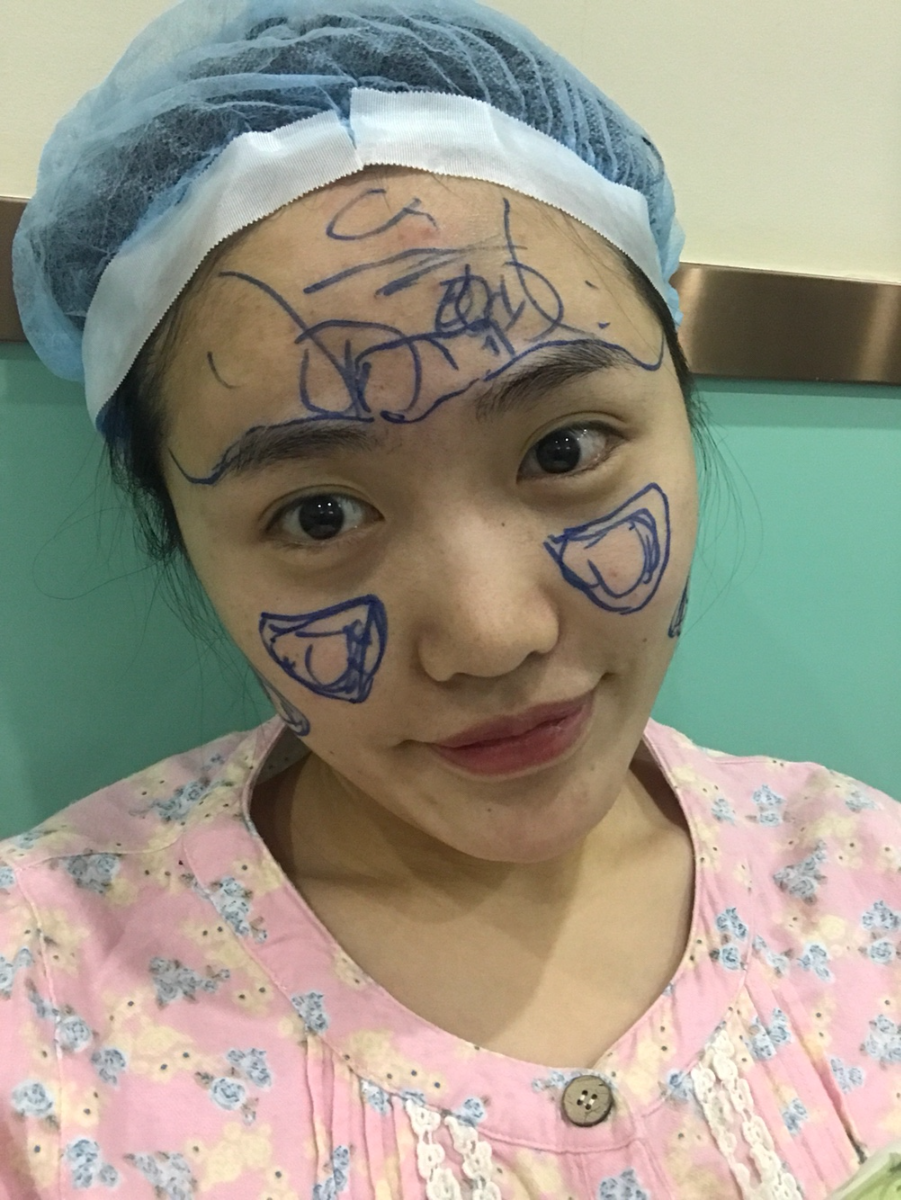 北京星美李寧輝進口膨體隆鼻案例效果對比圖，鼻子自然又美麗