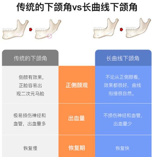 下頜角磨骨手術(shù)介紹