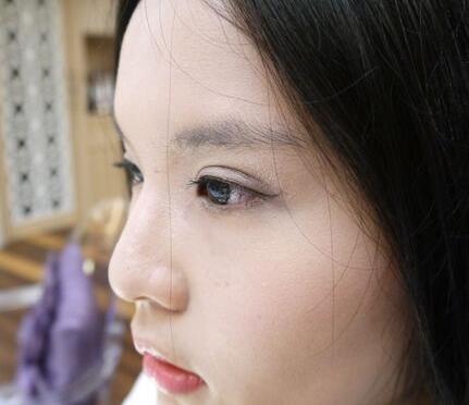 做完雙眼皮手術(shù)恢復(fù)后的效果 做完雙眼皮手術(shù)恢復(fù)后的效果