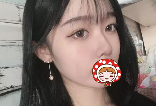 廈門海峽整形美容醫(yī)院隆鼻手術(shù)案例最終效果 廈門海峽整形美容醫(yī)院隆鼻手術(shù)案例最終效果