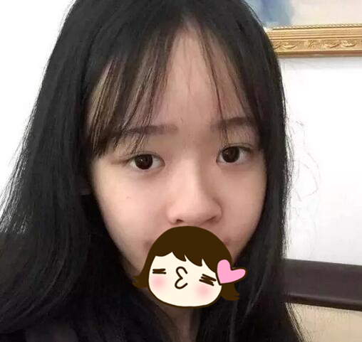 廈門海峽整形美容醫(yī)院醫(yī)生張宏隆鼻案例，效果很棒