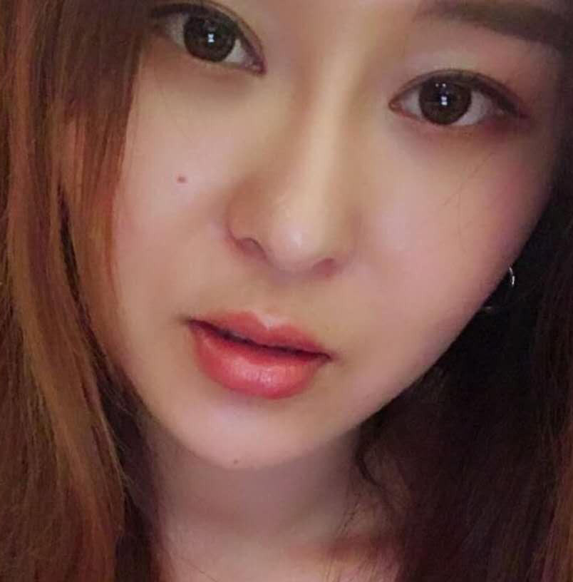 玻尿酸豐唇手術(shù)術(shù)后效果 玻尿酸豐唇手術(shù)術(shù)后效果