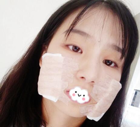 下頜角案例手術(shù) 下頜角案例手術(shù)