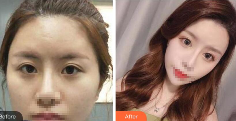 鄭州風(fēng)信子整形醫(yī)院雙眼皮案例效果圖對比