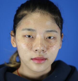 激光祛斑之前。