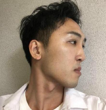 下頜角磨骨手術(shù)之前