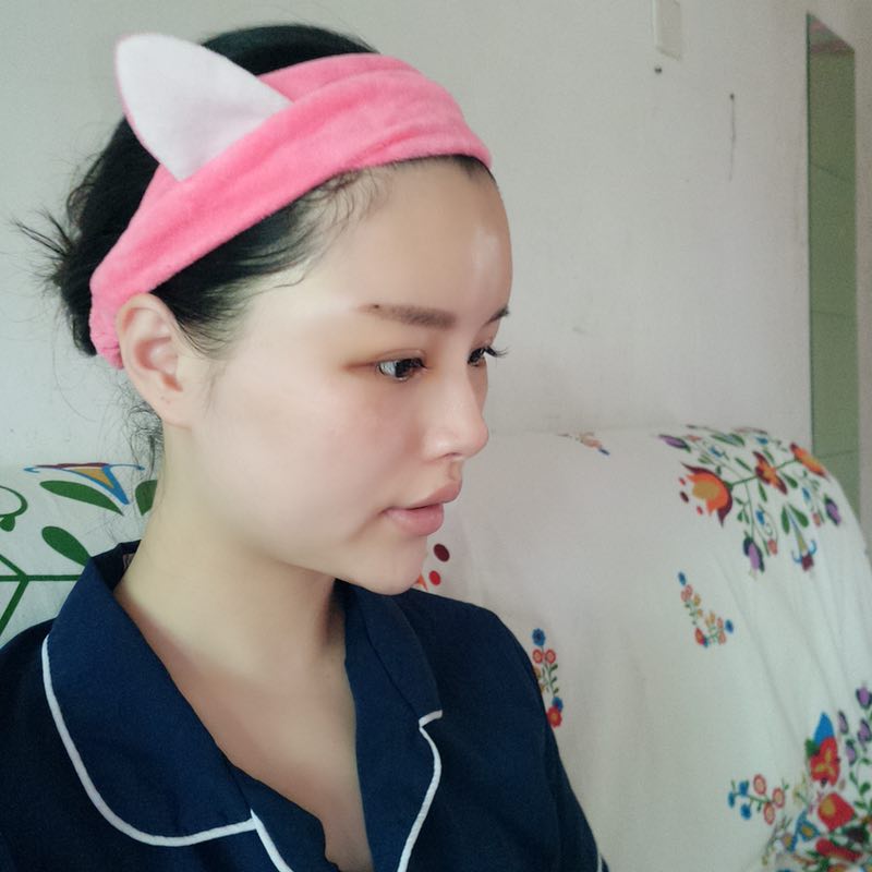 自體脂肪填充臉部案例效果圖 自體脂肪填充臉部案例效果圖