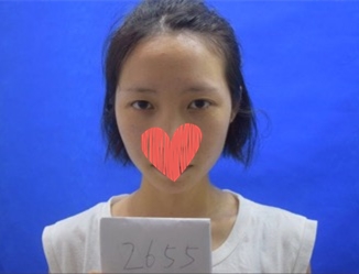 杜園園開外眼角案例效果對比圖