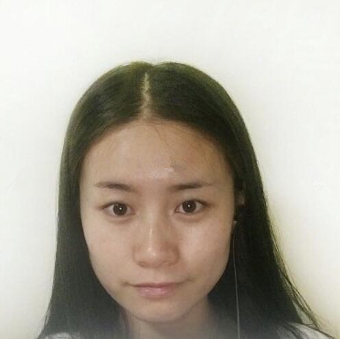 長(zhǎng)沙愛思特整形醫(yī)生楊千里雙眼皮修復(fù)案例效果對(duì)比圖