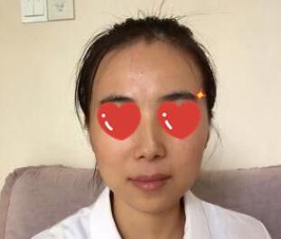 熊師玻尿酸隆下巴案例分享