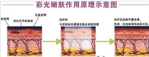 彩光嫩膚原理示意圖 彩光嫩膚原理示意圖
