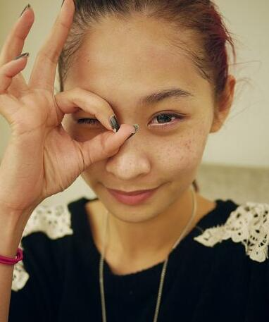 北京悅秀醫(yī)療整形專家楊勇山做激光去黃褐斑效果怎么樣？真實案例展示