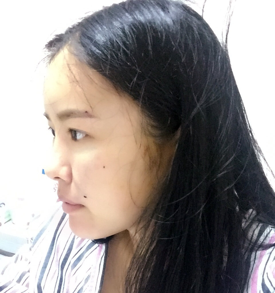 手術(shù)當(dāng)天 手術(shù)當(dāng)天