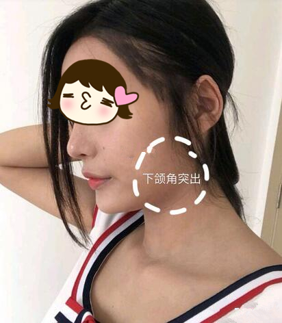 磨骨手術(shù)之前