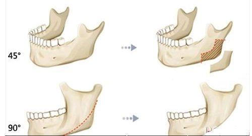 磨骨手術(shù)的介紹