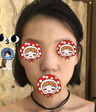 北京京韓醫(yī)療硅膠隆鼻案例 北京京韓醫(yī)療硅膠隆鼻案例