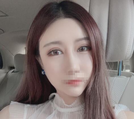 北京彤美整形醫(yī)院專家李長賦做鼻部綜合整形怎么樣?李長賦鼻綜合案例反饋 北京彤美整形醫(yī)院專家李長賦做鼻部綜合整形怎么樣?李長賦鼻綜合案例反饋