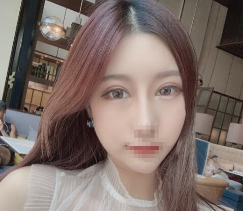 鼻綜合整形手術(shù)恢復(fù)效果 鼻綜合整形手術(shù)恢復(fù)效果