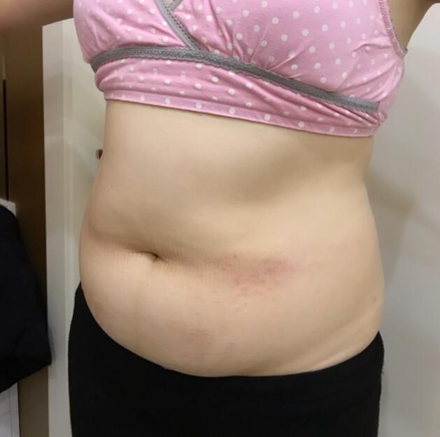 廣州星團(tuán)醫(yī)學(xué)整形醫(yī)生顧鵬做腹部吸脂效果怎么樣?顧鵬腹部吸脂案例展示 廣州星團(tuán)醫(yī)學(xué)整形醫(yī)生顧鵬做腹部吸脂效果怎么樣?顧鵬腹部吸脂案例展示