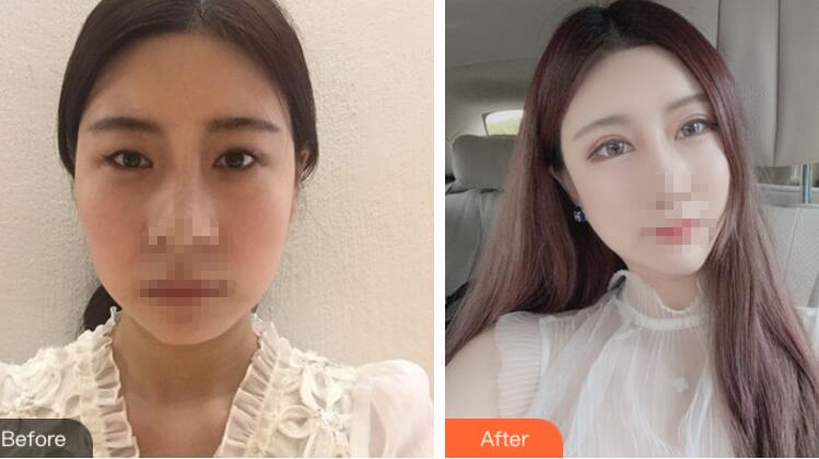 北京彤美整形醫(yī)院專家李長賦做鼻部綜合整形怎么樣?李長賦鼻綜合案例反饋 北京彤美整形醫(yī)院專家李長賦做鼻部綜合整形怎么樣?李長賦鼻綜合案例反饋