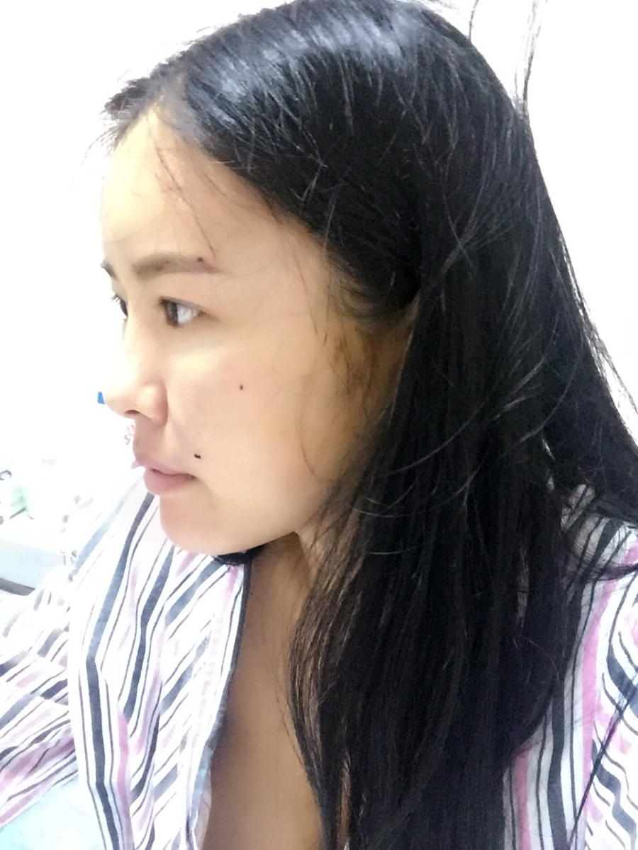 西安莎曼妃醫(yī)療美容醫(yī)院醫(yī)生樸俊做自體脂肪豐太陽穴效果怎么樣？