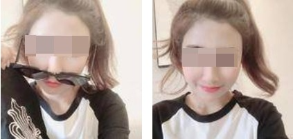 昆明麗都整形醫(yī)生孟春麗做面部自體脂肪填充效果怎么樣？